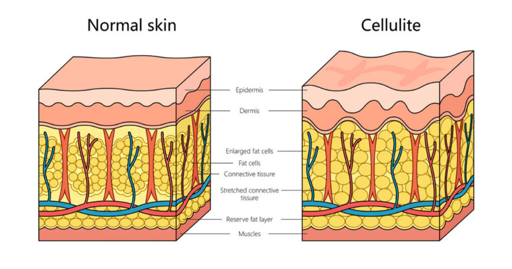 Illustration of skin layers showing thinning dermis and connective tissue changes.